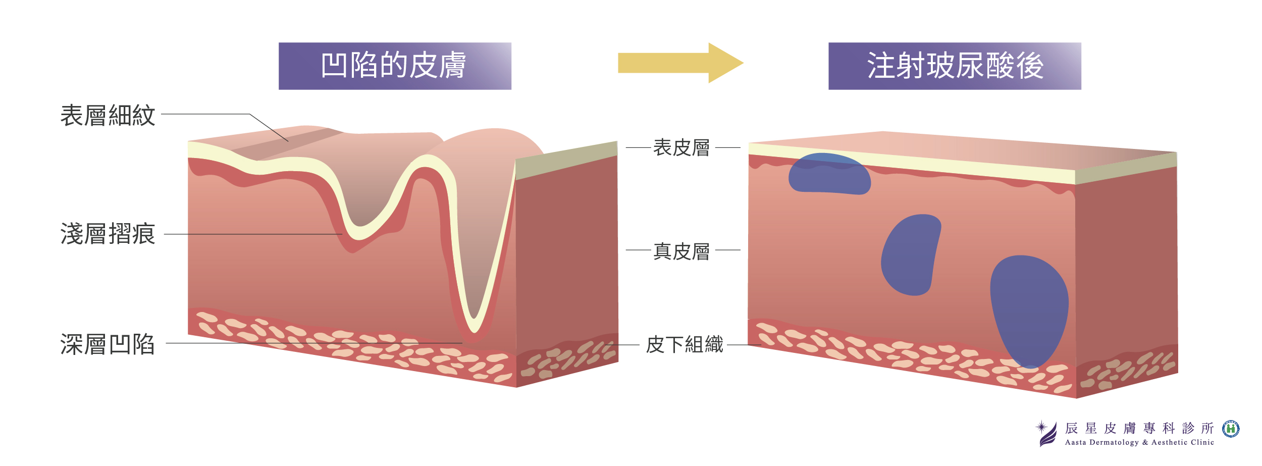 玻尿酸注射