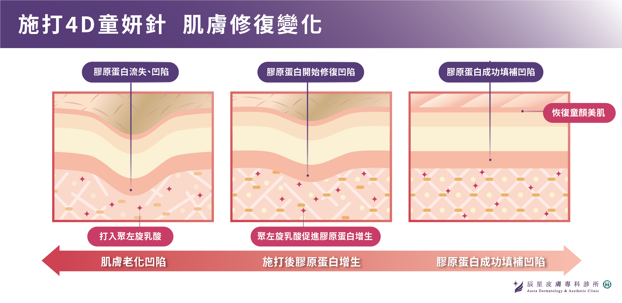 童顏針效果