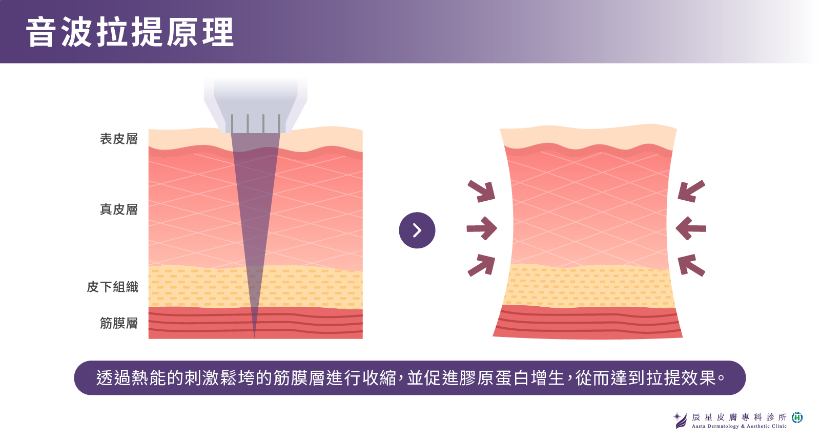 音波拉提原理